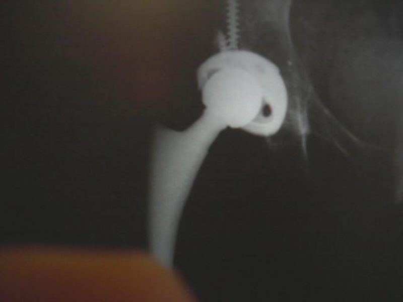 Hip Prostheses:  Total, Primary:  Unidentified (Implant 4240)